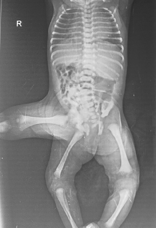 X-ray of the pelvis (anteroposterior view).